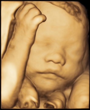 3D ultralyd sent i svangerskapet